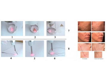 Kosmetikgerät, Fraktionierte CO2-Laserbehandlung / Fraktionierte CO2-Lasertherapie